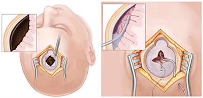 Solve the post-operative subdural pneumatosis of chronic subdural hematoma: A novel active bone hole drainage system